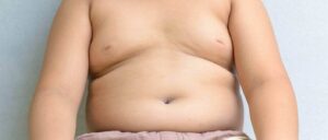 obesity and overeating